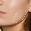 Masseter Botox