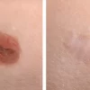 Mole Removals