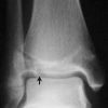 Salter-harris Fracture