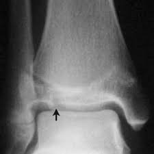Salter-harris Fracture