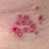Anal Herpes