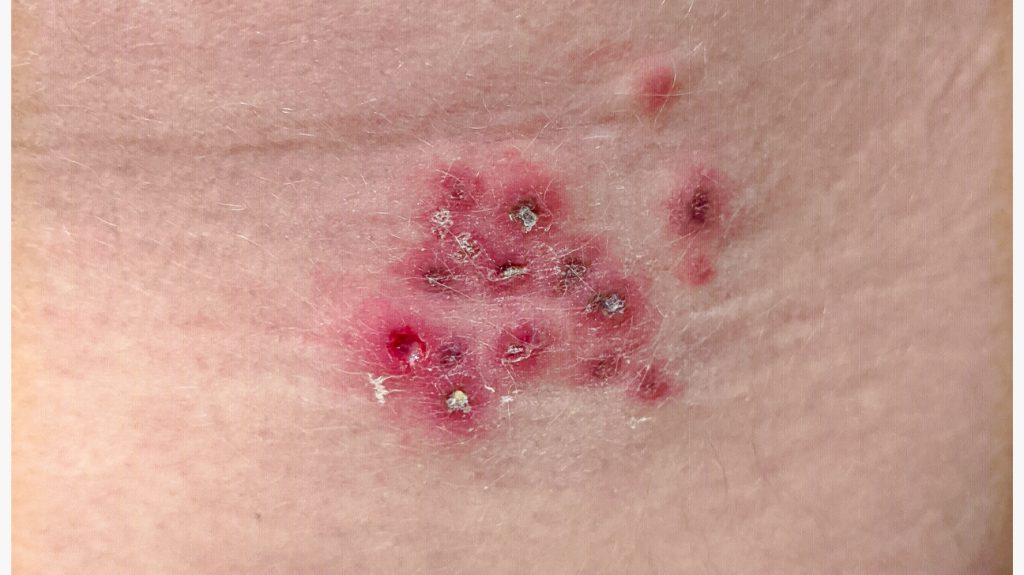Anal Herpes