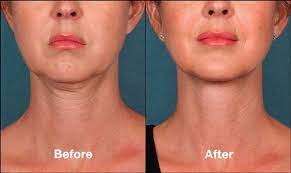Kybella Cost