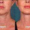 Kybella Cost