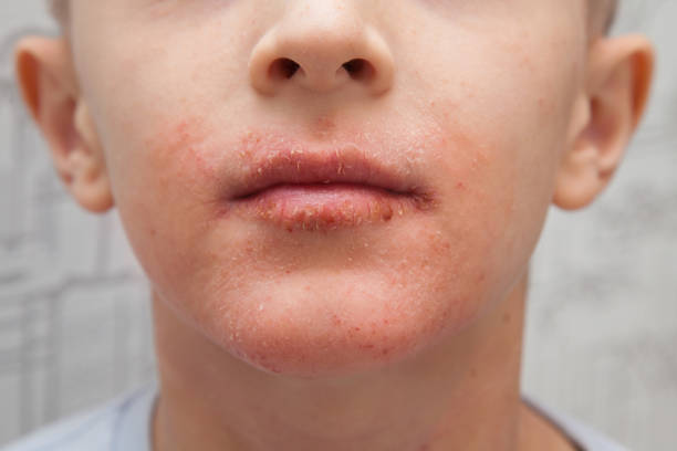 Teething rash